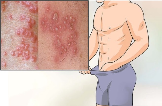 Jual Obat Sipilis De Nature Pengiriman ke Ternate