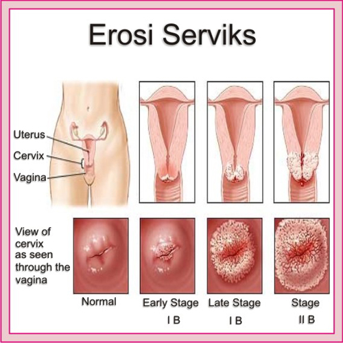 Jual Obat Sipilis De Nature Pengiriman ke Trenggalek